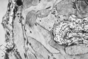 M,6y. | the wall of an arachnoid cyst